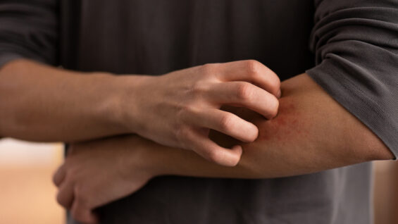 Le psoriasis : préjugés et réalités