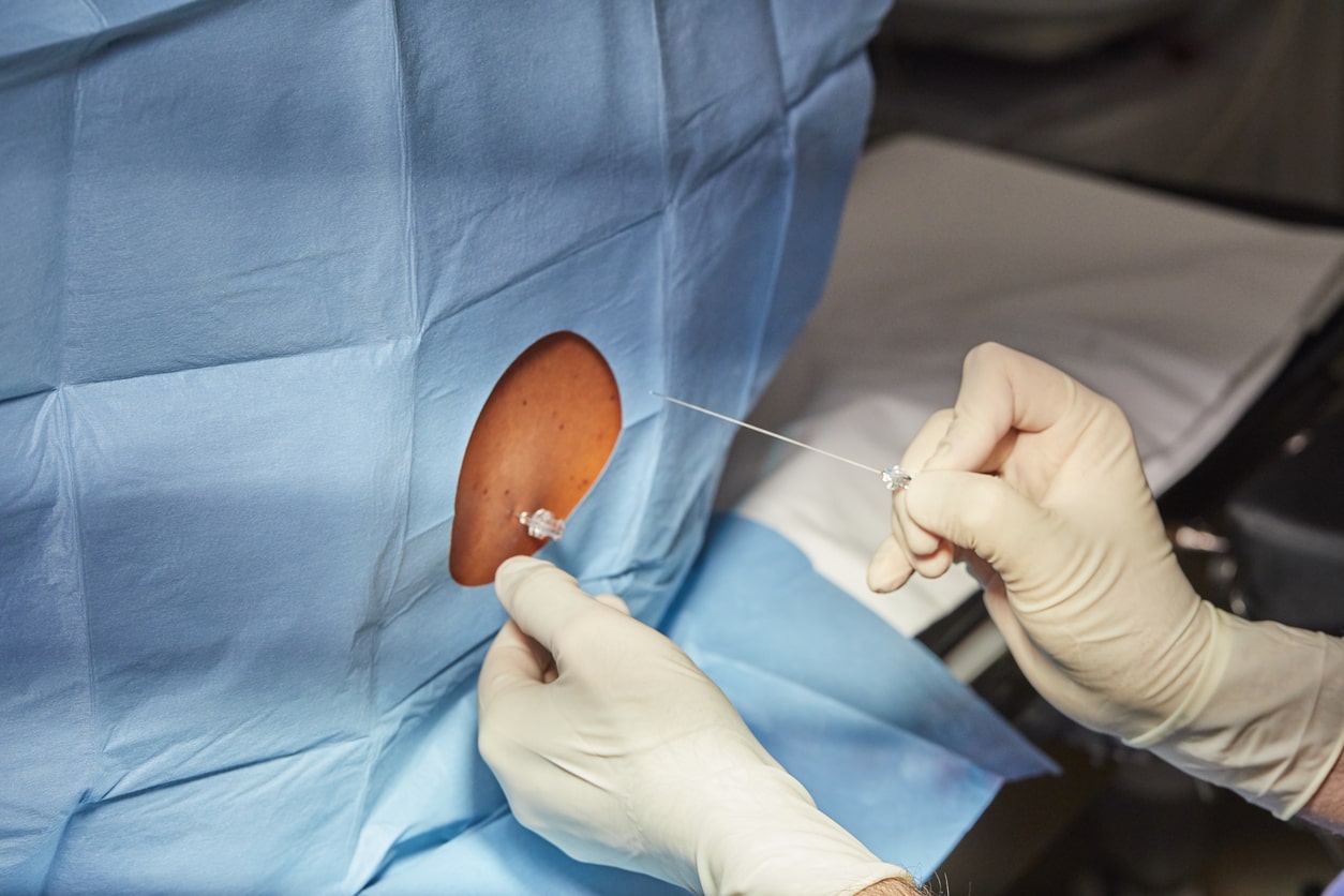 Accouchement : la péridurale pour minimiser les risques de complications post-partum